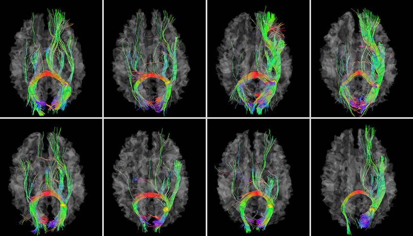 Diffuse Tension Imaging