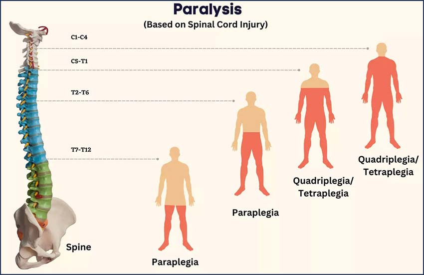 paralysis types