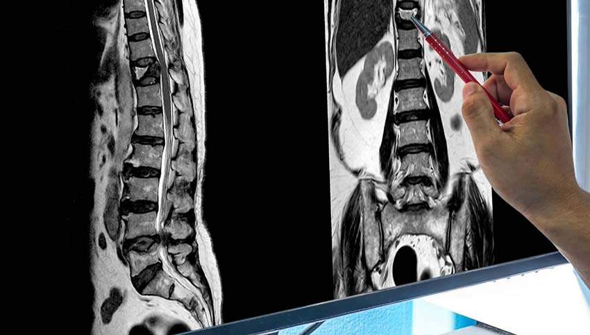 spinal cord compression MRI