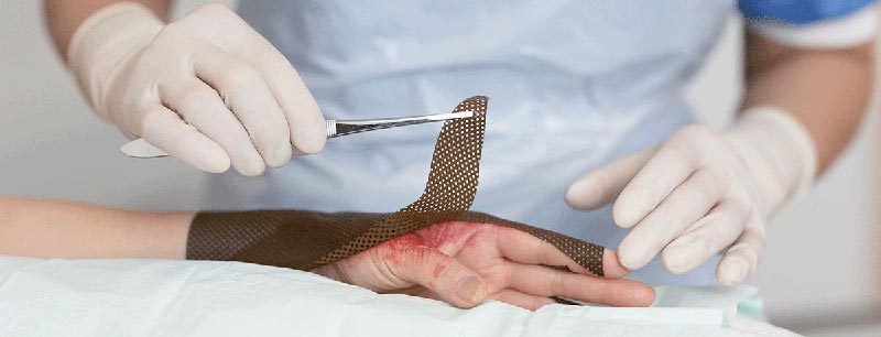 Catastrophic Burn Injuries